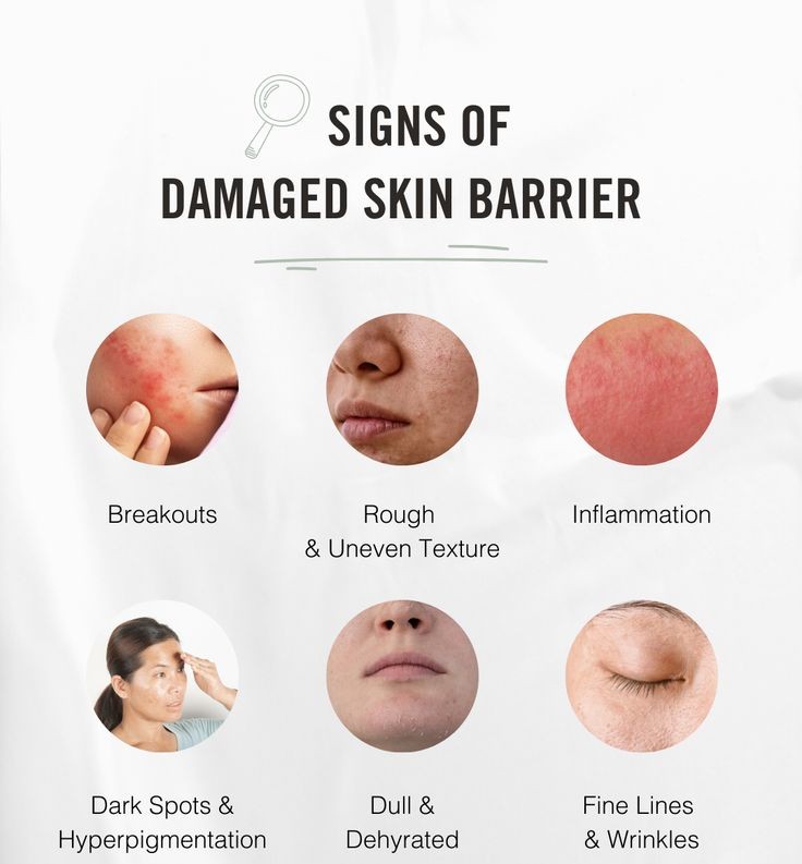 Image showing signs of a damaged skin barrier: breakouts, rough texture, inflammation, dark spots, dehydration, and fine lines.