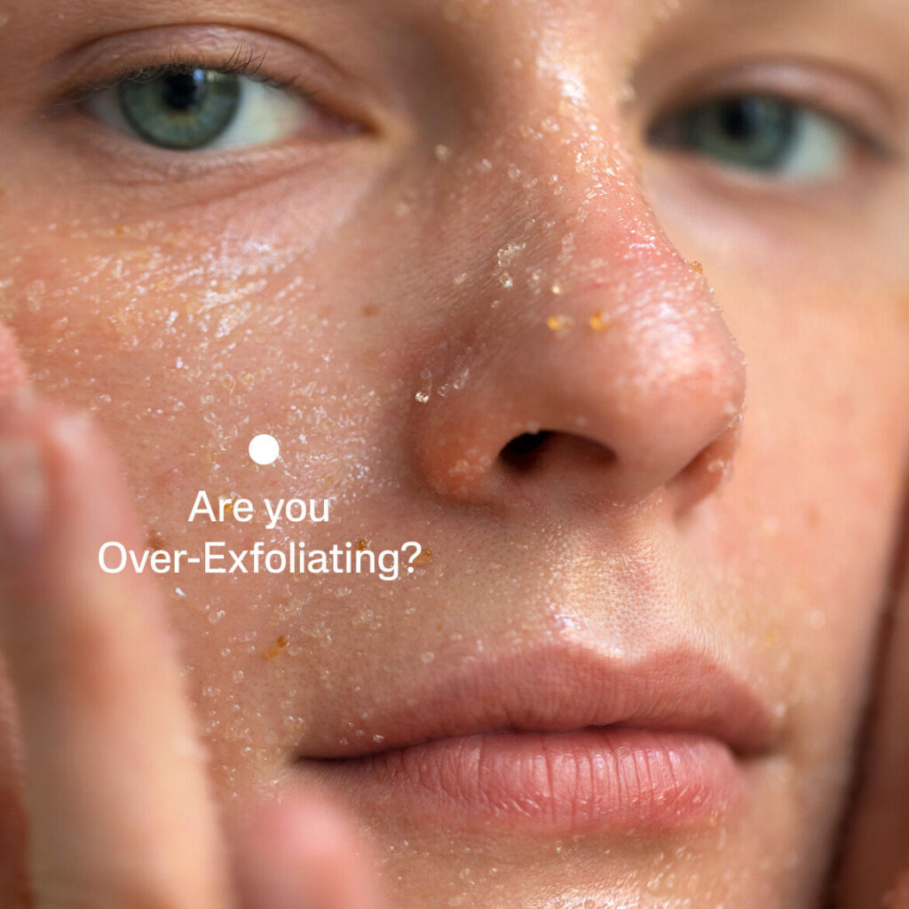 Irritated skin with redness and flakiness due to over-exfoliating, highlighting the risks of using face scrub daily.