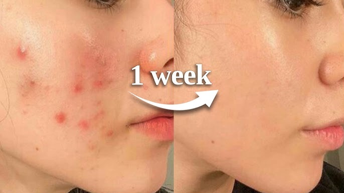 Before and after results showing visible improvement in acne and redness after 1 week of skin barrier repair.